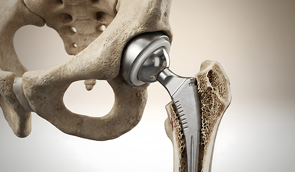 Total Hip Replacement In Dallas